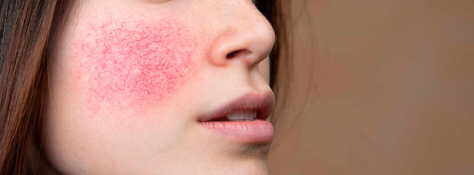 Rostro de mujer afectaro por la rosácea.